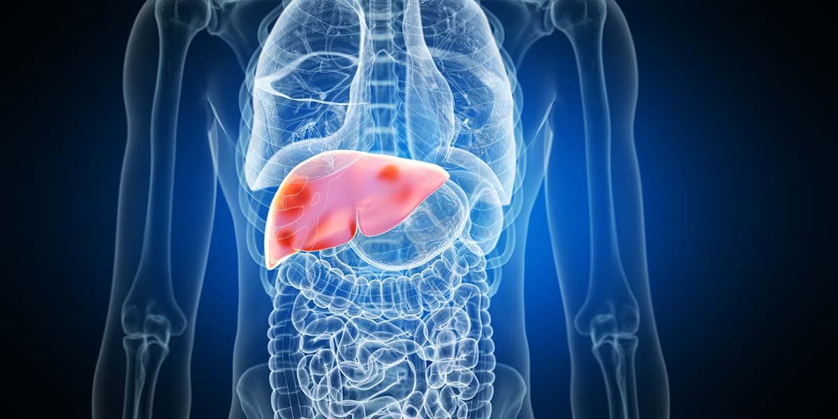 Liver cancer