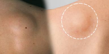 Lipoma