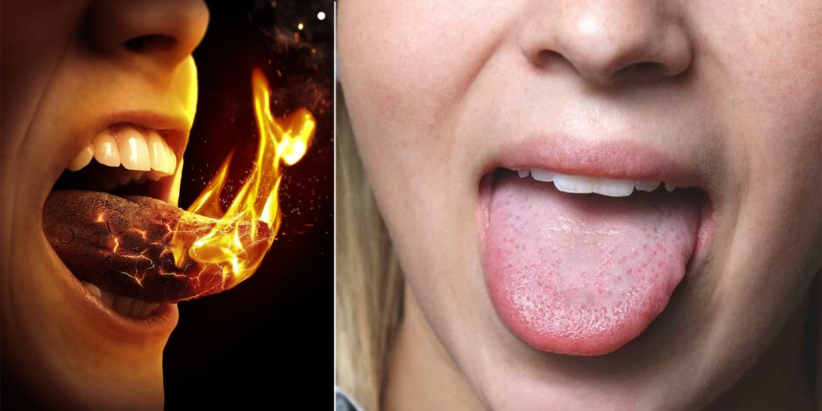 Burning tongue