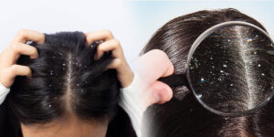 Dandruff Cure