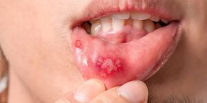 Mouth Ulcers