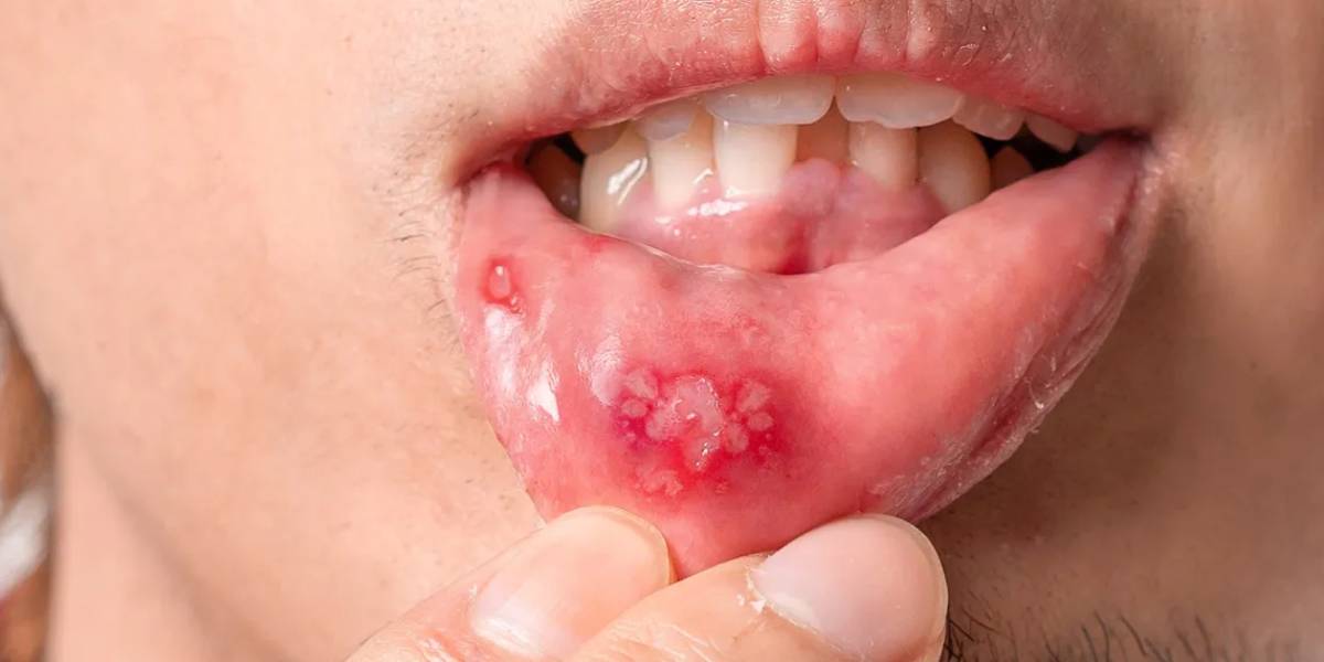 Mouth Ulcers