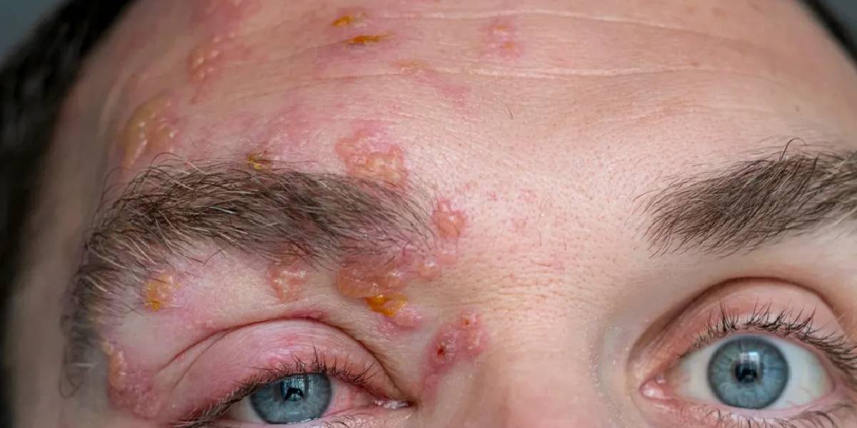 shingles diseases