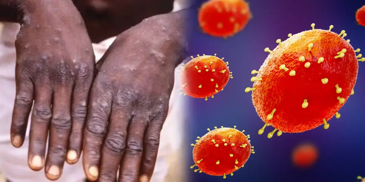 Monkey Pox Virus