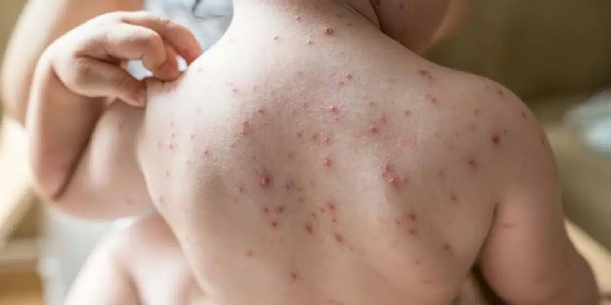 chicken pox (1)